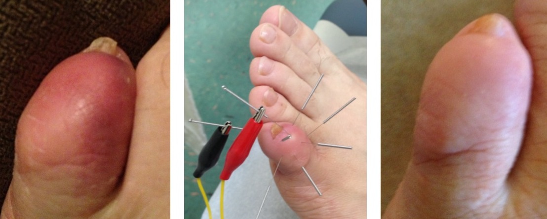 Electric Acupuncture for Traumatic Injury at Small Toe