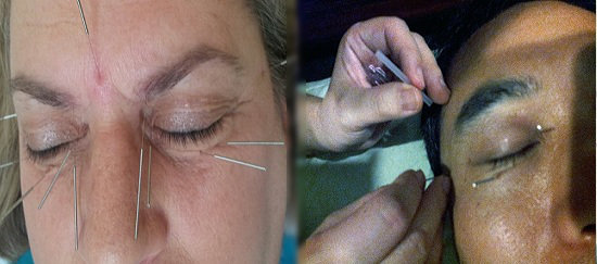 Acupuncture for Macular Degeneration